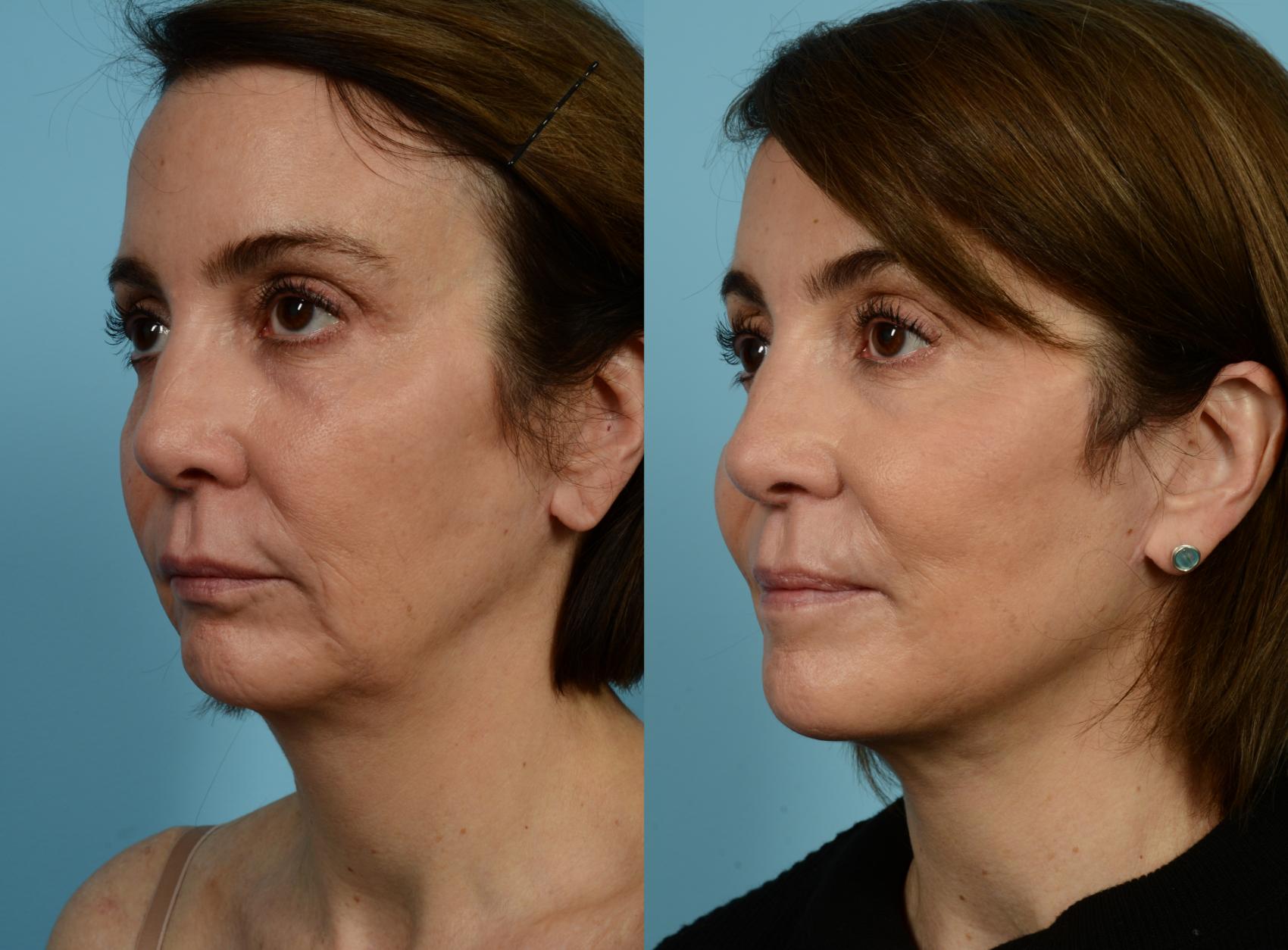 Before & After Fat Grafting by Dr. Mustoe Case 940 Left Oblique View in Chicago, IL