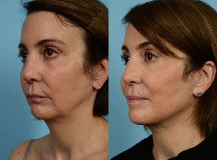 Before & After Deep Plane Facelift by Dr. Mustoe Case 940 Left Oblique View in Chicago, IL