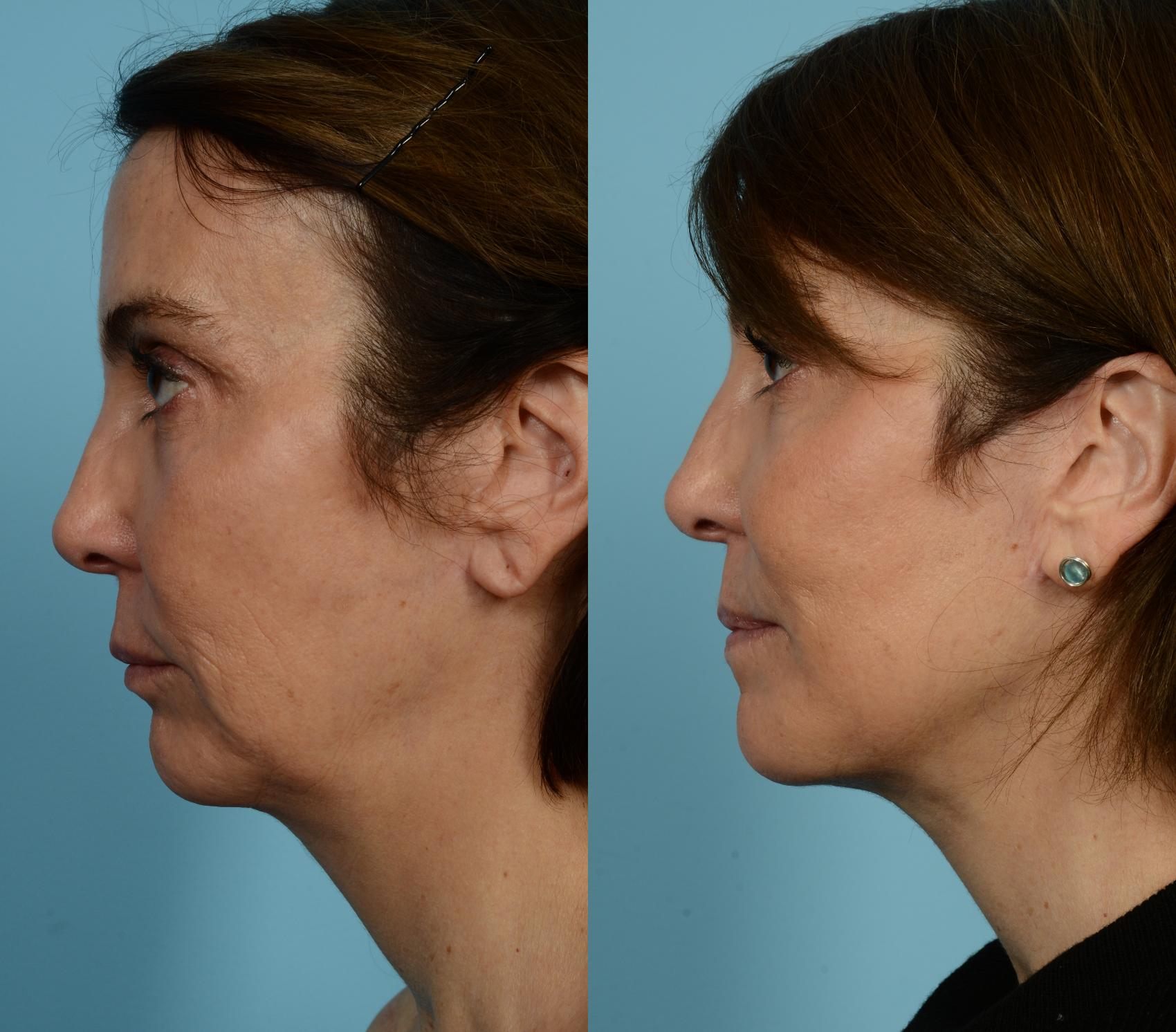 Before & After Fat Grafting by Dr. Mustoe Case 940 Left Side View in Chicago, IL
