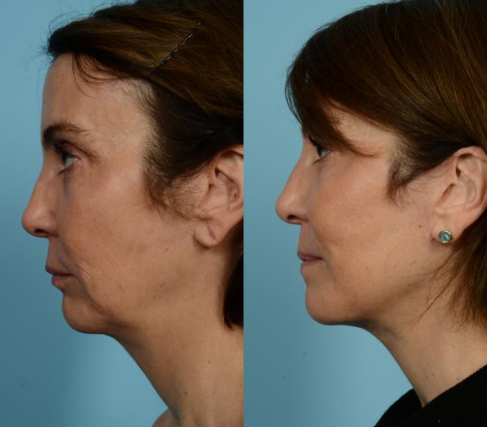Before & After Deep Plane Facelift by Dr. Mustoe Case 940 Left Side View in Chicago, IL