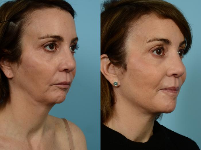 Before & After Deep Plane Facelift by Dr. Mustoe Case 940 Right Oblique View in Chicago, IL