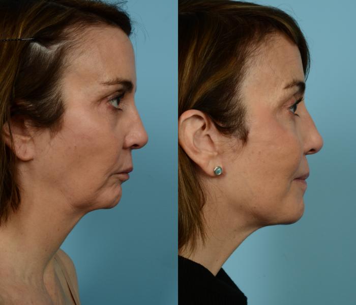 Before & After Deep Plane Facelift by Dr. Mustoe Case 940 Right Side View in Chicago, IL