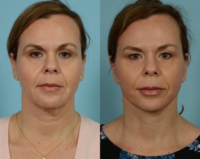 Before & After Neck Lift by Dr. Mustoe Case 941 Front View in Chicago, IL