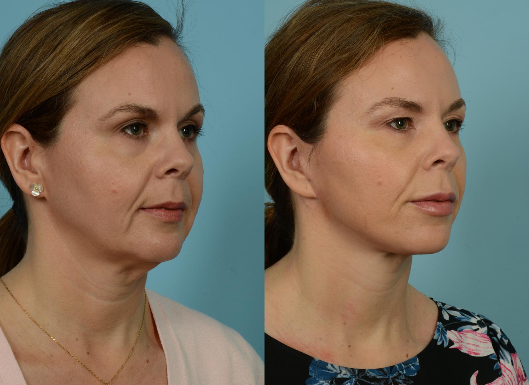 Before & After Neck Lift by Dr. Mustoe Case 941 Right Oblique View in Chicago, IL