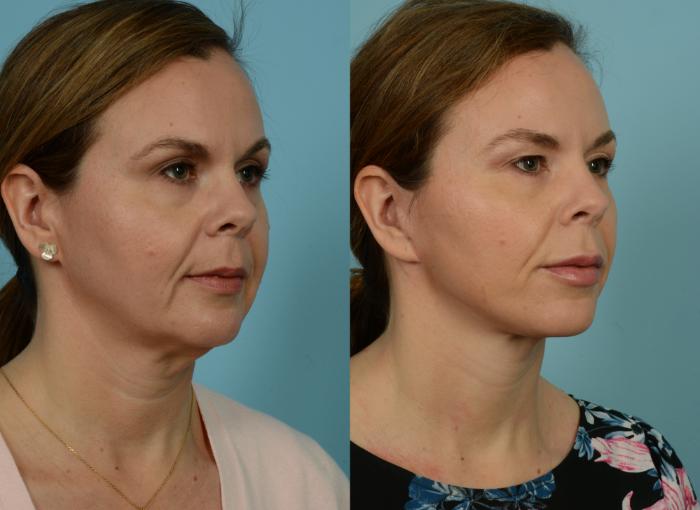 Before & After Neck Lift by Dr. Mustoe Case 941 Right Oblique View in Chicago, IL