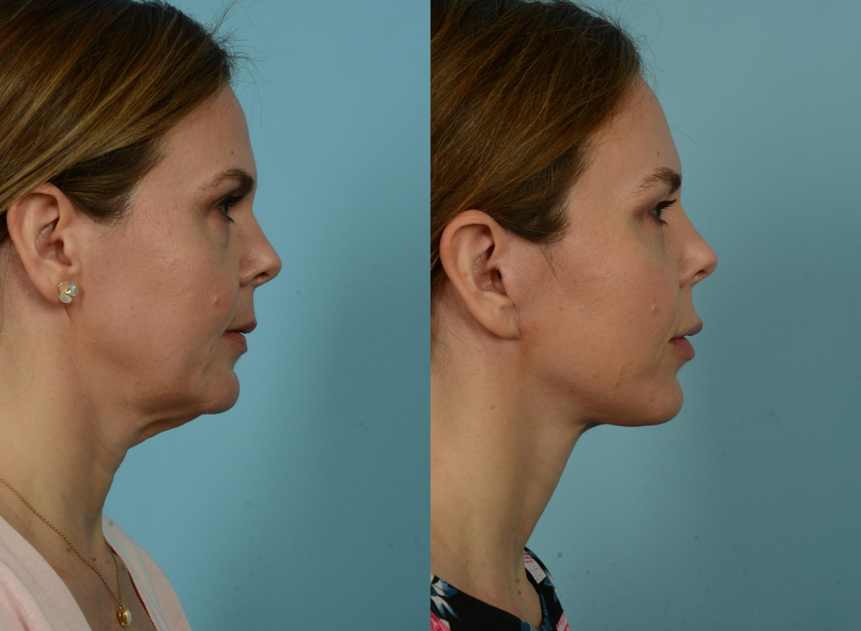 Before & After Deep Plane Facelift by Dr. Mustoe Case 941 Right Side View in Chicago, IL