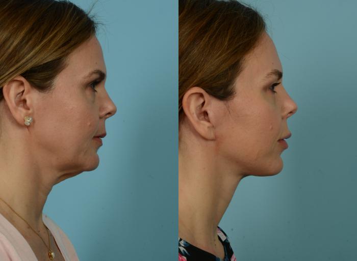 Before & After Neck Lift by Dr. Mustoe Case 941 Right Side View in Chicago, IL