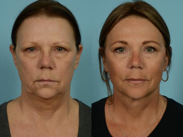 Before & After Deep Plane Facelift by Dr. Mustoe Case 973 Front View in Chicago, IL