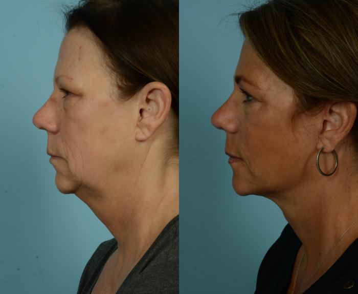 Before & After Deep Plane Facelift by Dr. Mustoe Case 973 Left Side View in Chicago, IL
