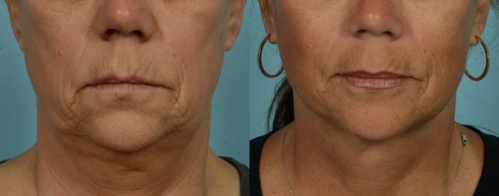 Before & After Deep Plane Facelift by Dr. Mustoe Case 973 Mouth View in Chicago, IL