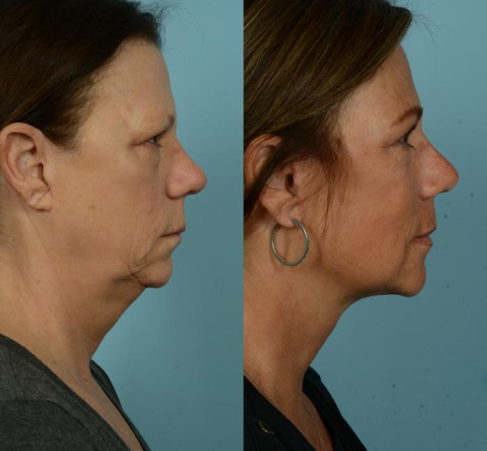 Before & After Deep Plane Facelift by Dr. Mustoe Case 973 Right Side View in Chicago, IL