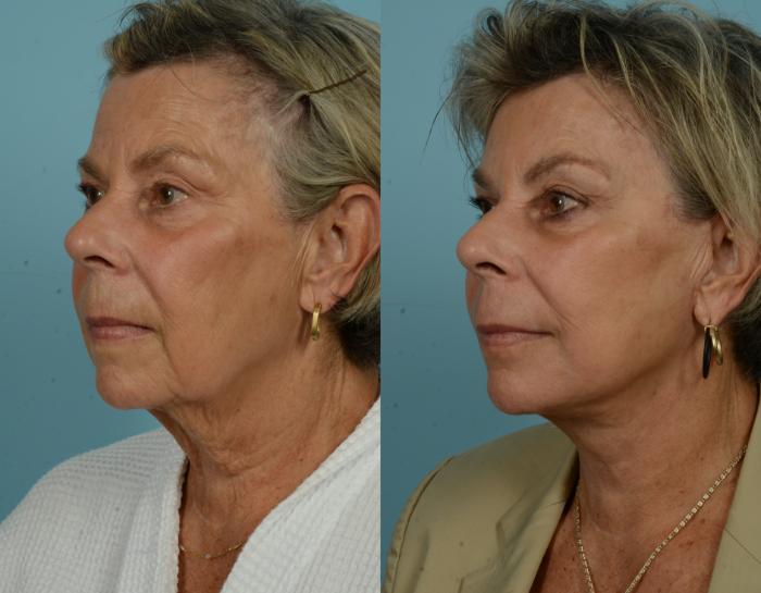 Before & After Deep Plane Facelift by Dr. Mustoe Case 997 Left Oblique View in Chicago, IL