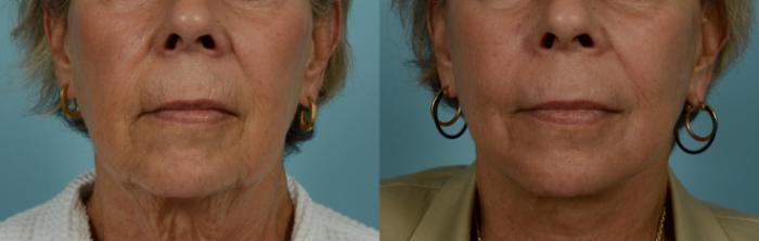 Before & After Deep Plane Facelift by Dr. Mustoe Case 997 Mouth View in Chicago, IL
