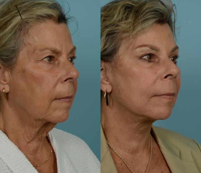 Before & After Deep Plane Facelift by Dr. Mustoe Case 997 Right Oblique View in Chicago, IL