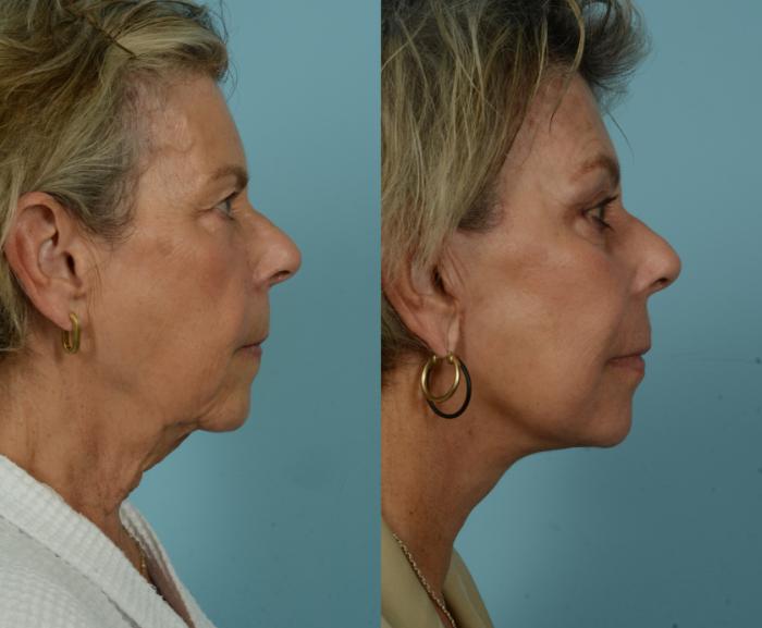 Before & After Deep Plane Facelift by Dr. Mustoe Case 997 Right Side View in Chicago, IL
