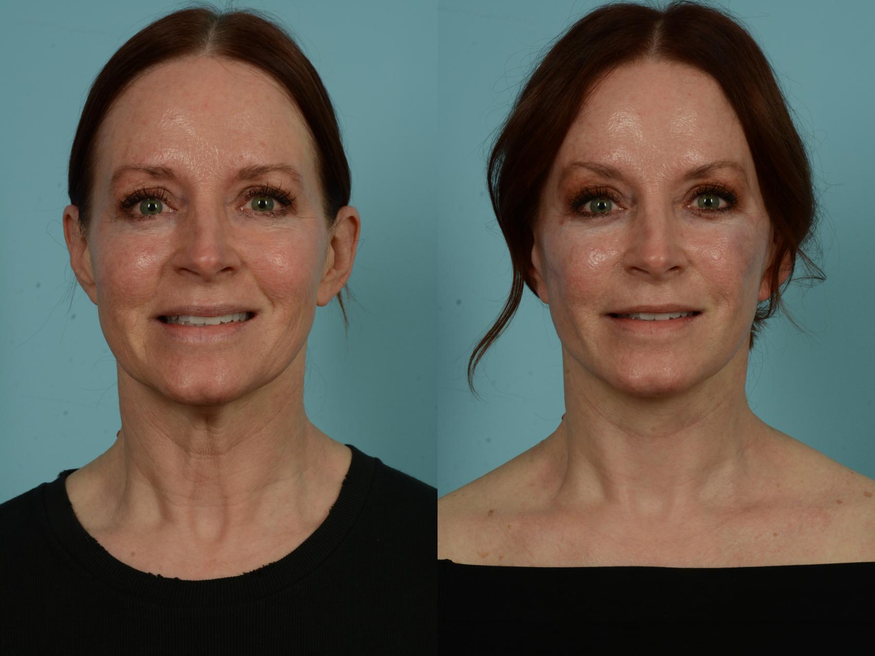 Before & After Dual Plane Facelift by Dr. Sinno Case 1011 Front View in Chicago, IL