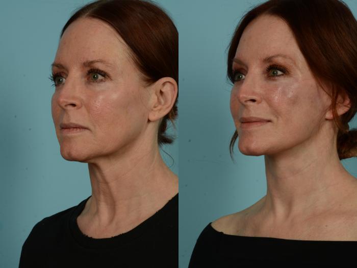 Before & After Dual Plane Facelift by Dr. Sinno Case 1011 Left Oblique View in Chicago, IL