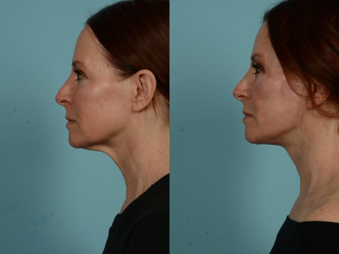 Before & After Dual Plane Facelift by Dr. Sinno Case 1011 Left Side View in Chicago, IL