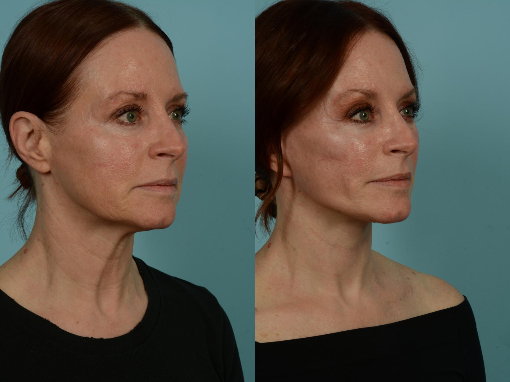 Before & After Dual Plane Facelift by Dr. Sinno Case 1011 Right Oblique View in Chicago, IL