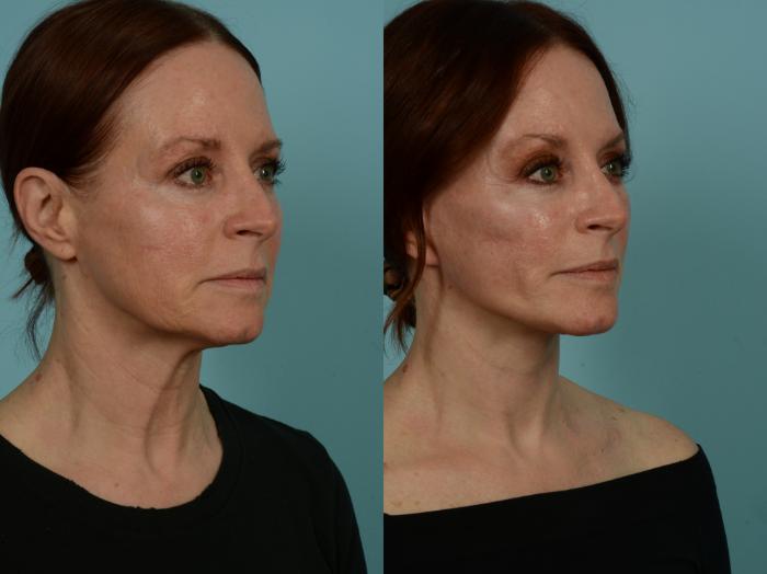 Before & After Dual Plane Facelift by Dr. Sinno Case 1011 Right Oblique View in Chicago, IL