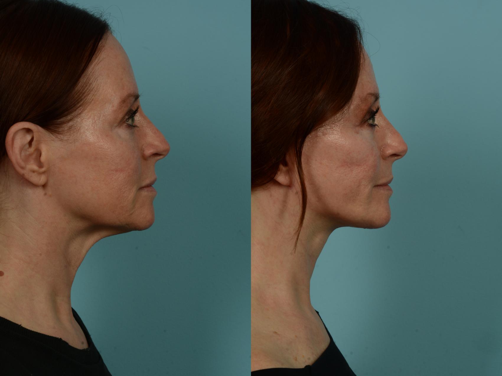 Before & After Dual Plane Facelift by Dr. Sinno Case 1011 Right Side View in Chicago, IL