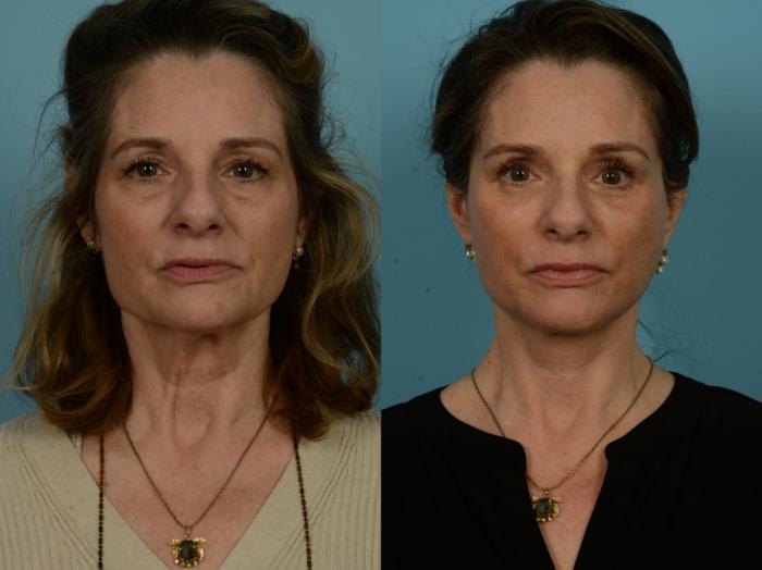 Before & After Dual Plane Facelift by Dr. Sinno Case 1095 Front View in Chicago, IL