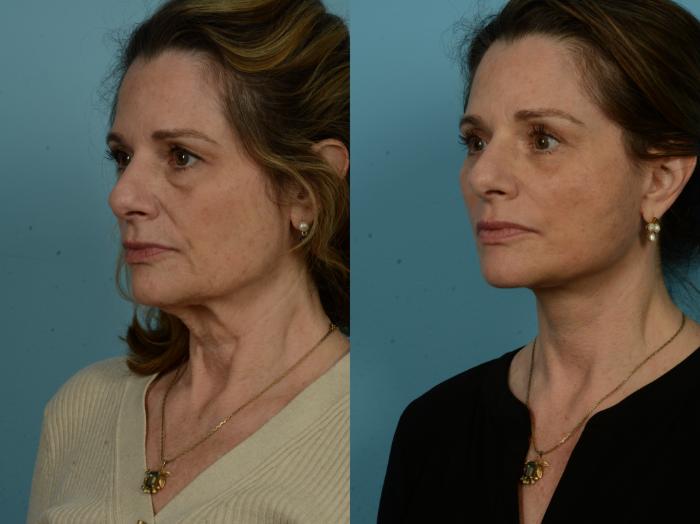 Before & After Dual Plane Facelift by Dr. Sinno Case 1095 Left Oblique View in Chicago, IL