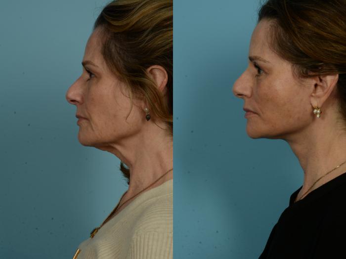 Before & After Dual Plane Facelift by Dr. Sinno Case 1095 Left Side View in Chicago, IL