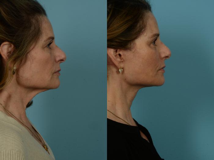 Before & After Dual Plane Facelift by Dr. Sinno Case 1095 Right Side View in Chicago, IL