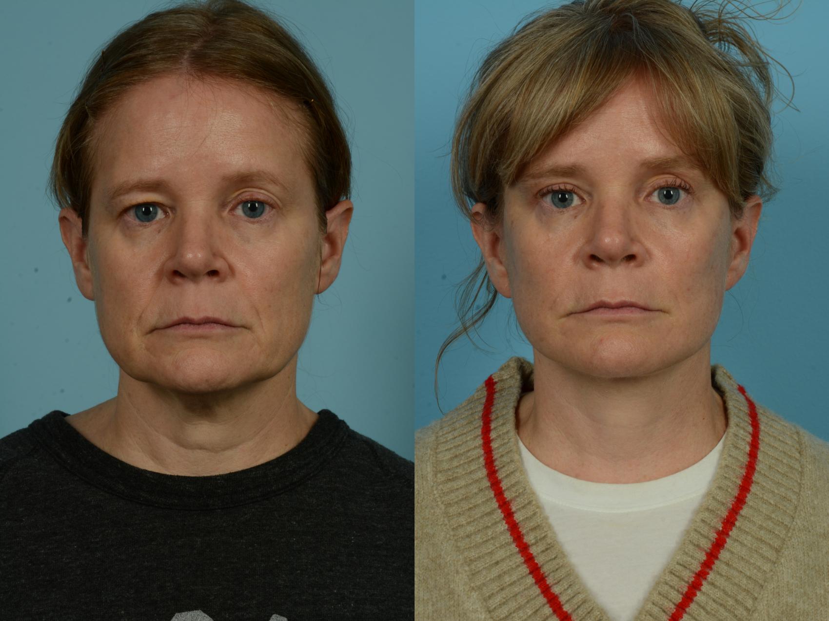 Before & After Dual Plane Facelift by Dr. Sinno Case 1104 Front View in Chicago, IL