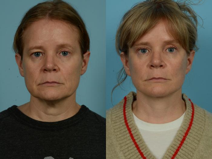 Before & After Dual Plane Facelift by Dr. Sinno Case 1104 Front View in Chicago, IL