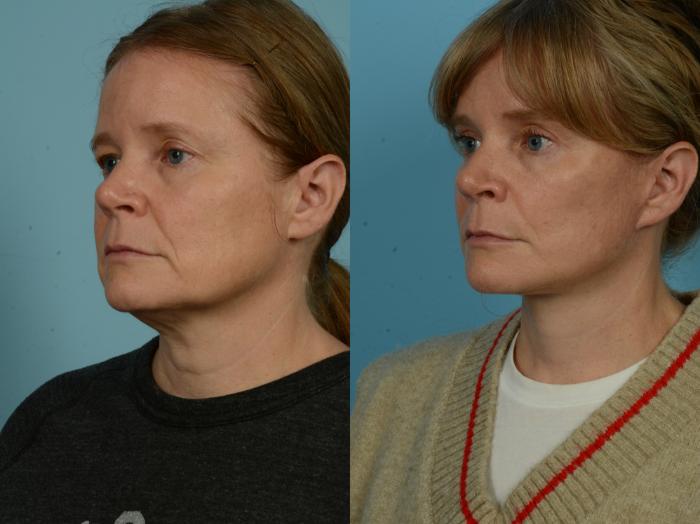 Before & After Dual Plane Facelift by Dr. Sinno Case 1104 Left Oblique View in Chicago, IL