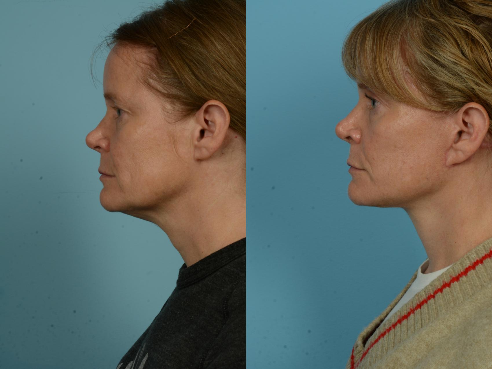 Before & After Dual Plane Facelift by Dr. Sinno Case 1104 Left Side View in Chicago, IL
