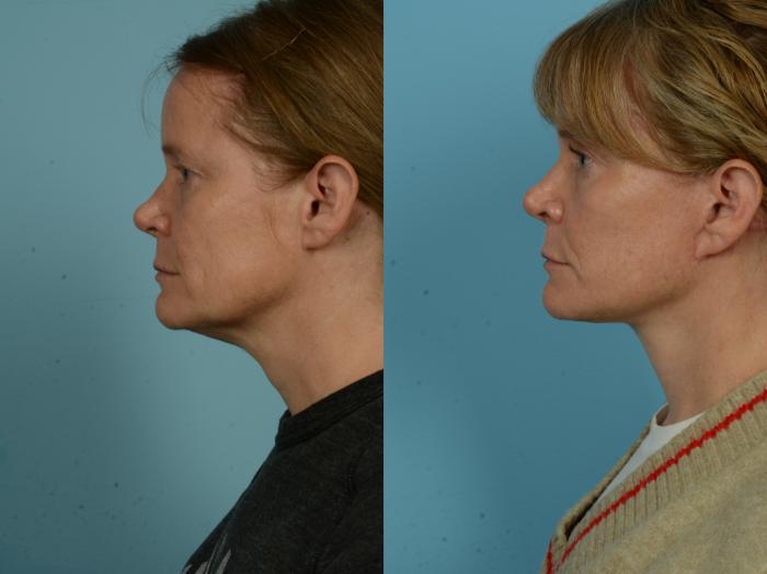 Before & After Dual Plane Facelift by Dr. Sinno Case 1104 Left Side View in Chicago, IL