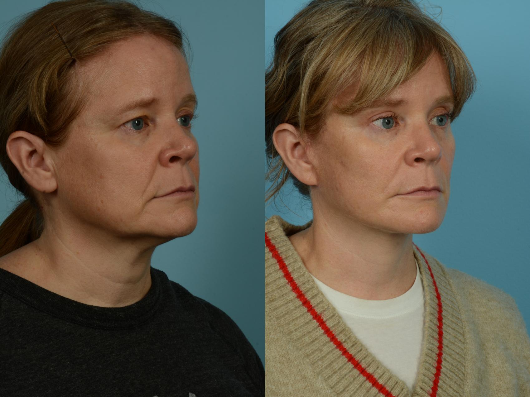 Before & After Dual Plane Facelift by Dr. Sinno Case 1104 Right Oblique View in Chicago, IL