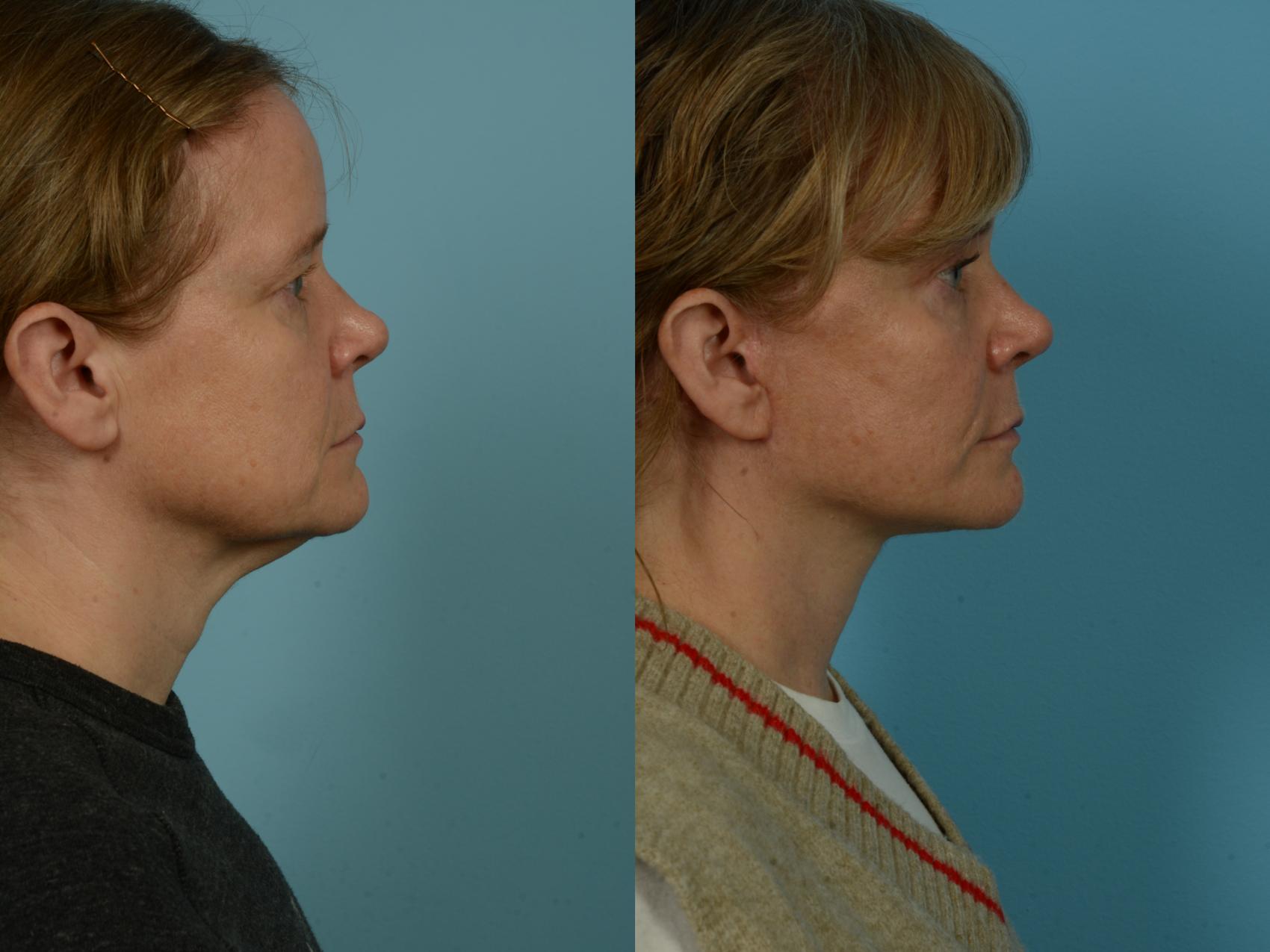 Before & After Dual Plane Facelift by Dr. Sinno Case 1104 Right Side View in Chicago, IL