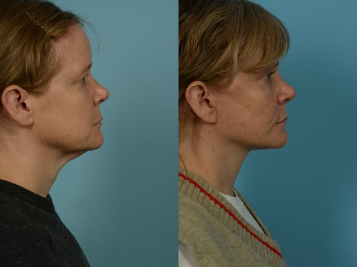 Before & After Dual Plane Facelift by Dr. Sinno Case 1104 Right Side View in Chicago, IL