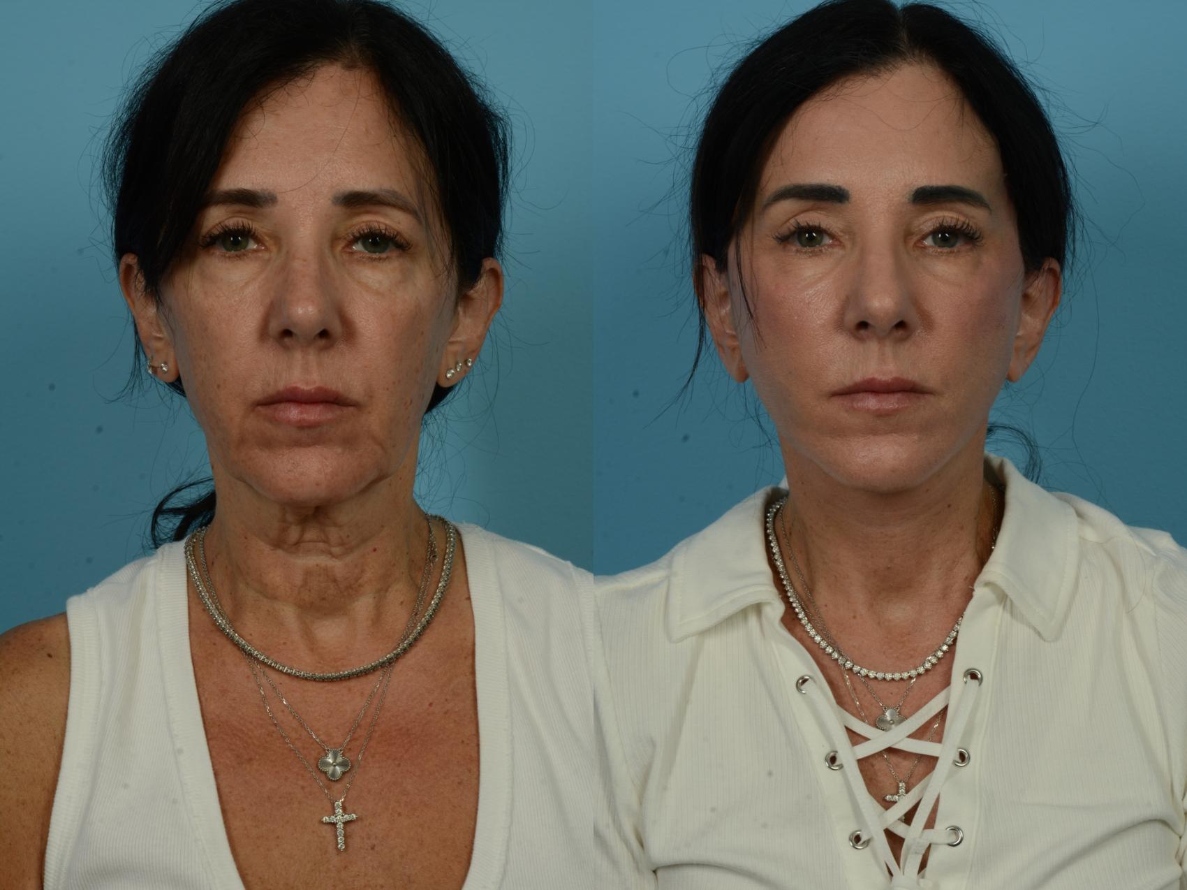 Before & After Dual Plane Facelift by Dr. Sinno Case 1110 Front View in Chicago, IL