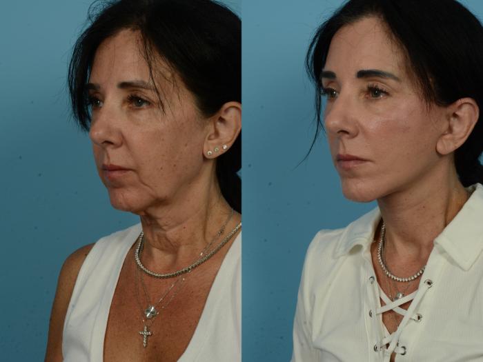 Before & After Dual Plane Facelift by Dr. Sinno Case 1110 Left Oblique View in Chicago, IL