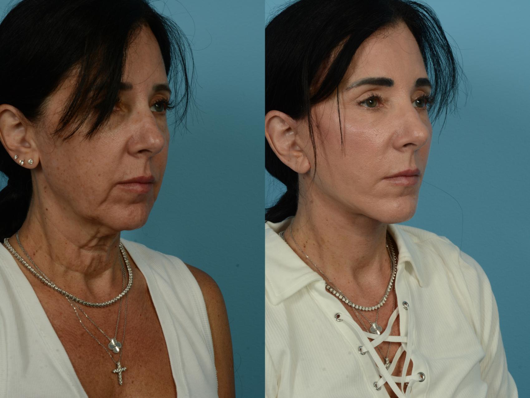 Before & After Dual Plane Facelift by Dr. Sinno Case 1110 Right Oblique View in Chicago, IL