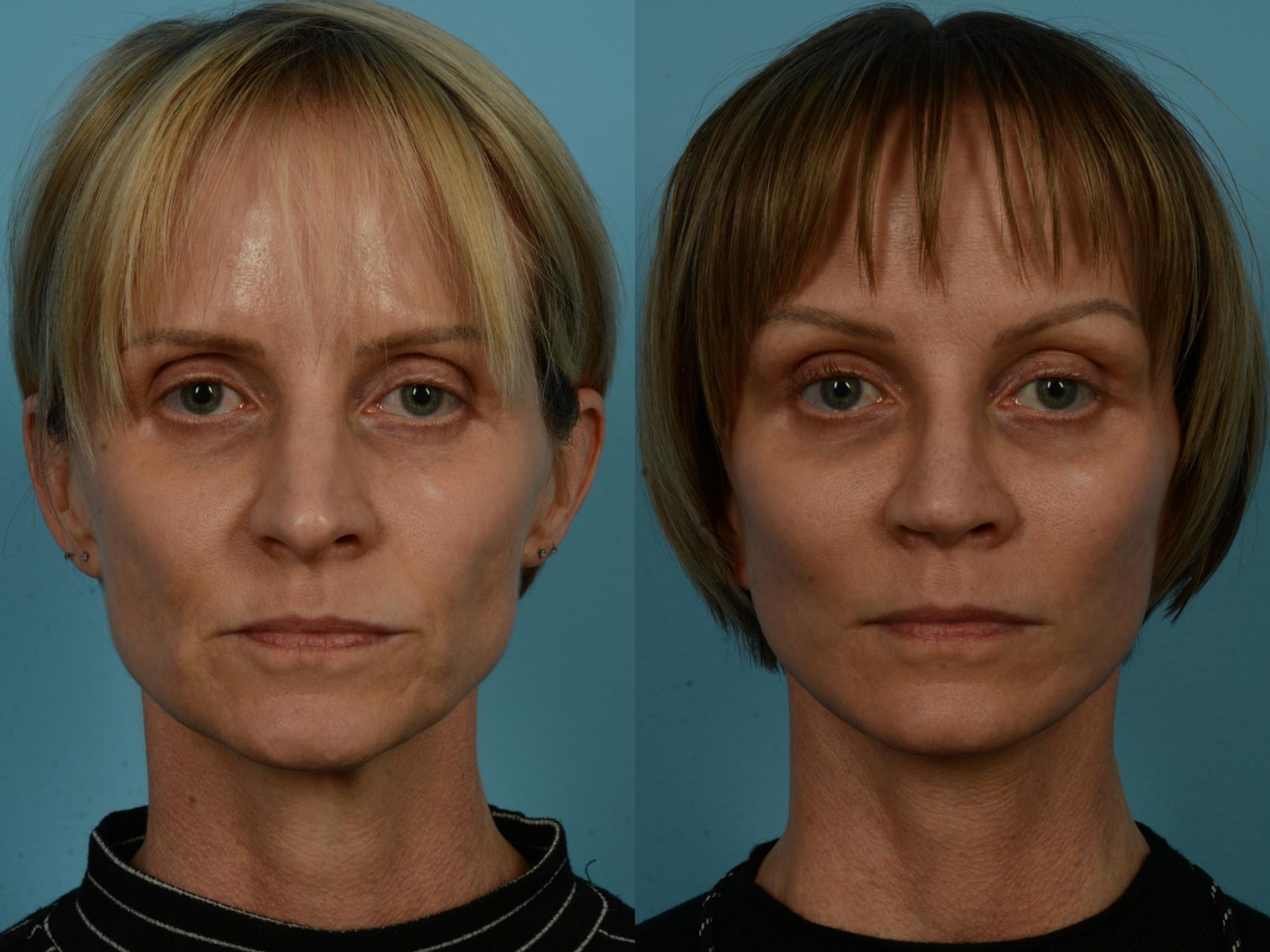 Before & After Dual Plane Facelift by Dr. Sinno Case 1119 Front View in Chicago, IL
