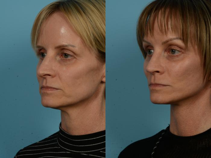 Before & After Dual Plane Facelift by Dr. Sinno Case 1119 Left Oblique View in Chicago, IL