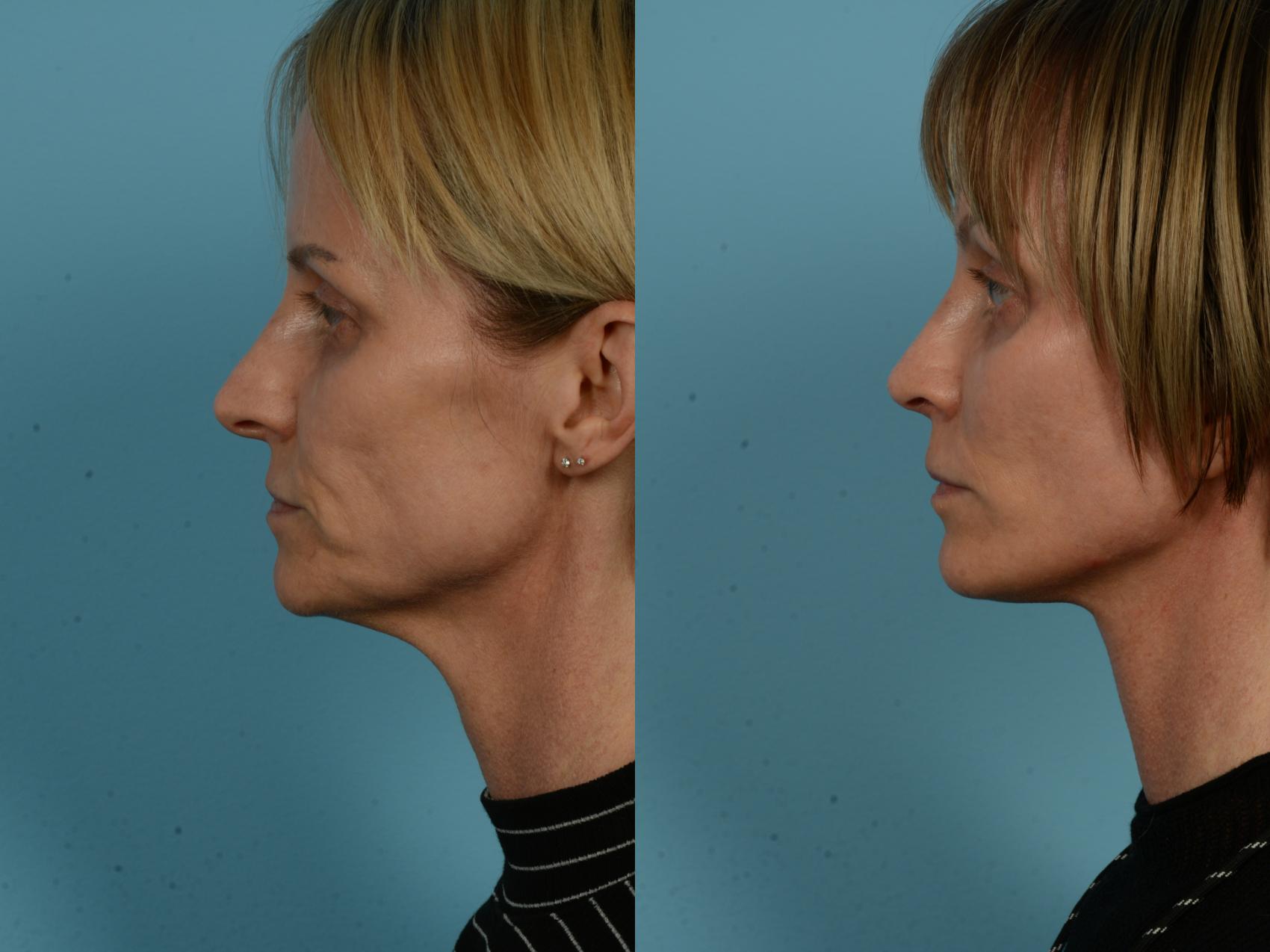Before & After Dual Plane Facelift by Dr. Sinno Case 1119 Left Side View in Chicago, IL