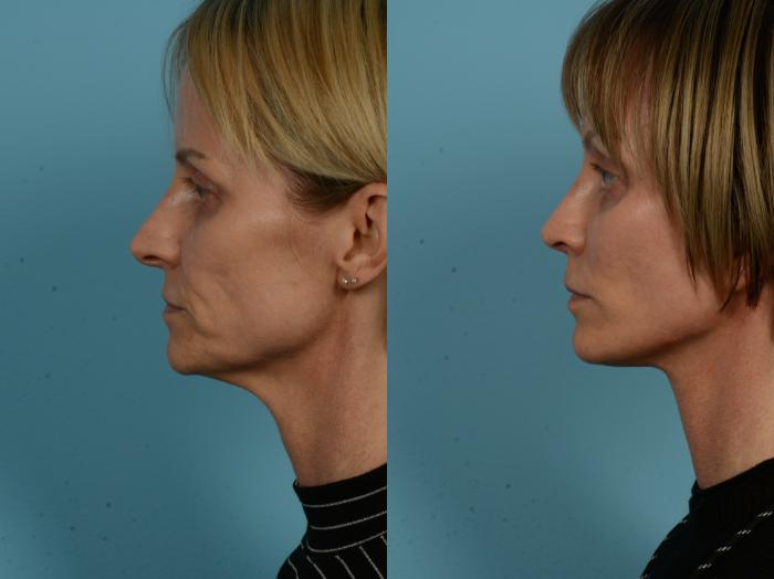 Before & After Dual Plane Facelift by Dr. Sinno Case 1119 Left Side View in Chicago, IL