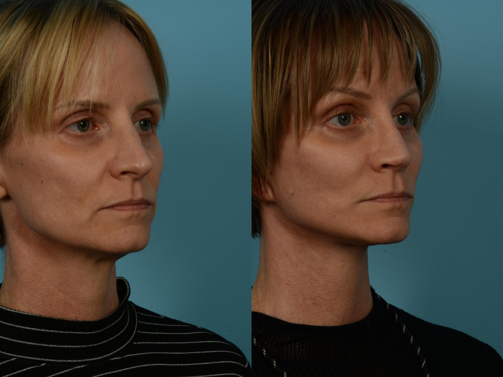 Before & After Dual Plane Facelift by Dr. Sinno Case 1119 Right Oblique View in Chicago, IL