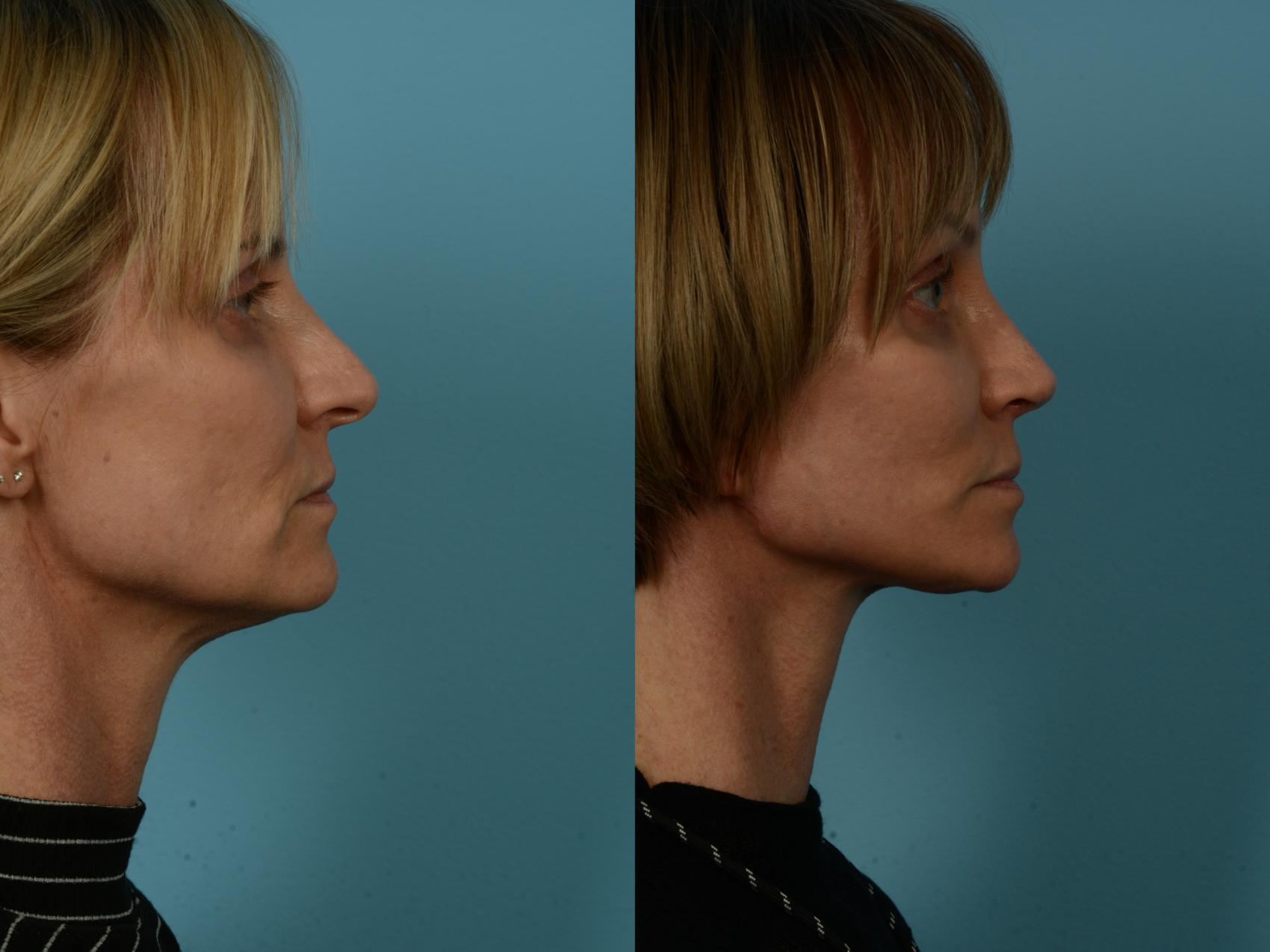 Before & After Dual Plane Facelift by Dr. Sinno Case 1119 Right Side View in Chicago, IL