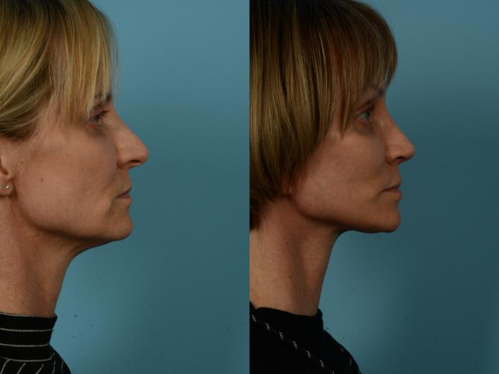 Before & After Dual Plane Facelift by Dr. Sinno Case 1119 Right Side View in Chicago, IL