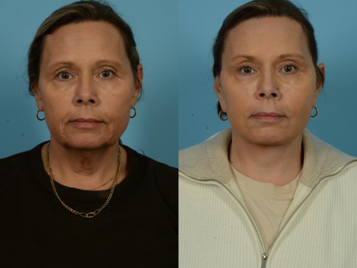 Before & After Dual Plane Facelift by Dr. Sinno Case 1122 Front View in Chicago, IL