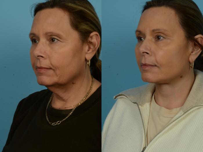 Before & After Dual Plane Facelift by Dr. Sinno Case 1122 Left Oblique View in Chicago, IL