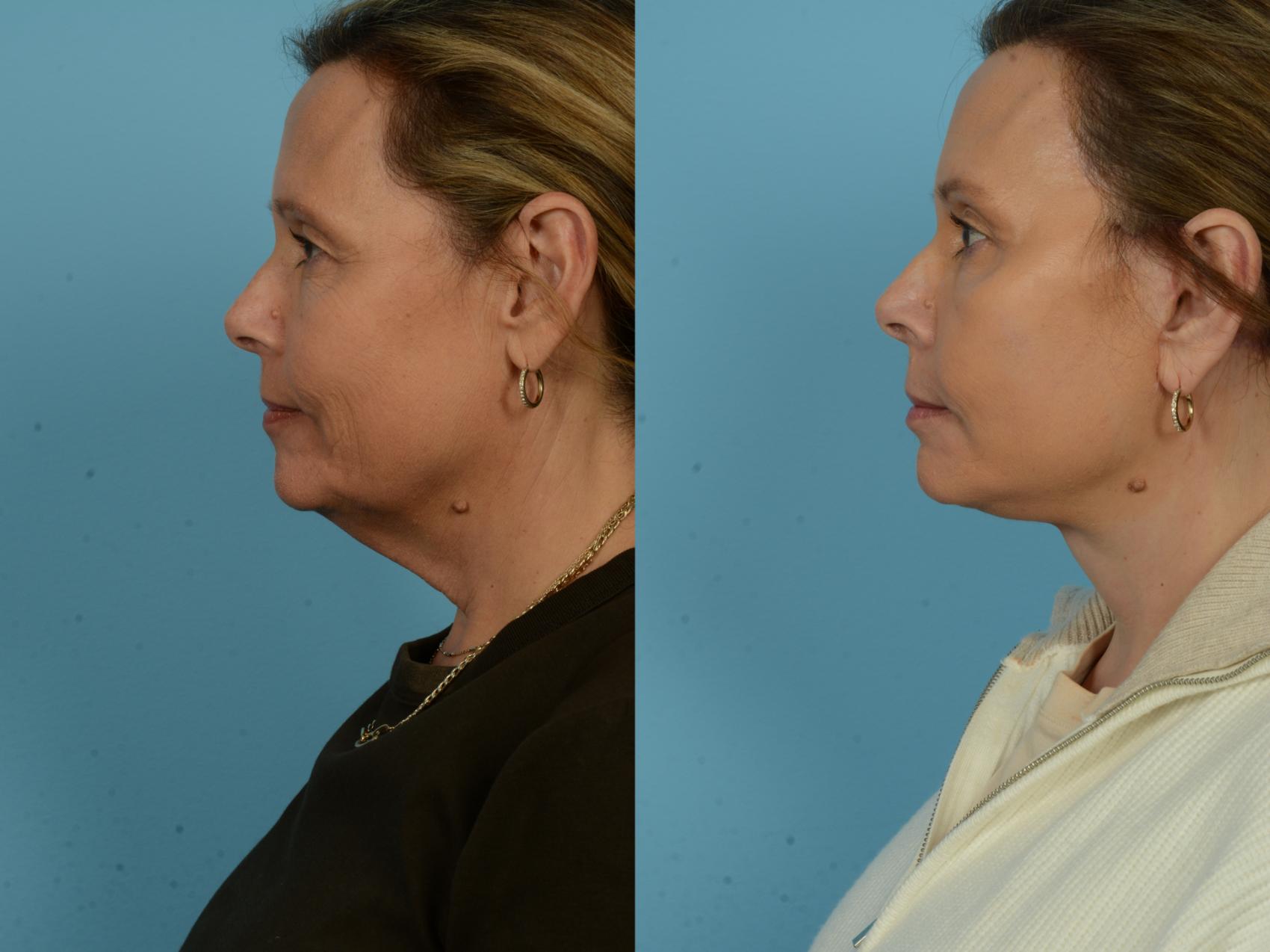 Before & After Dual Plane Facelift by Dr. Sinno Case 1122 Left Side View in Chicago, IL